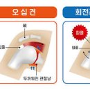 어깨회전근개파열 원인과 증상 치료법까지 이미지