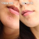 영플러스 | 올리브영 1위 케어플러스 트러블 흔적 패치 2주 사용 후기 솔직 정리