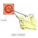 밍약국 | 자궁경부암 유소견 자궁경부확대술 그 후...조직검사 그리고 cin2 원추절제술 [1]