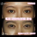 두한성형외과의원 | 🤍 쌍꺼풀 재수술 &amp; 애교살 자가지방이식 후기🤍