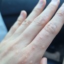 수포차 | 손에 작은 수포 손가락 물집 고생한 후기 (1일차)