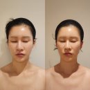 왈랑 | 위뷰티ㅣ위뷰티에서 솟은어깨 얼굴좌우비대칭 고민타파 완