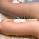 율공인중개사사무소 | 부평 피부관리샵 ‘월영에스테틱’에서 모공각화증 팔 관리받고 온 후기✨예신관리 추천