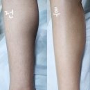 비엘메디칼 | 천안두정 왁싱&amp;피부관리샵 비엘뷰티에서 다리하프왁싱 하고왔어요.