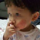 남가주식품 | 아이 아토피 치료후기 (동국대 이애영교수님, 순천향대 편복양 교수님)