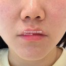 천호역 | 천호역피부과 슈링크후기 팔자주름·이중턱 리프팅 레이저 효과