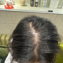 죽전정형외과의원 | 용인 죽전 수지 병원 두피문신 받기 전에 알아야 할 체크리스트 6가지