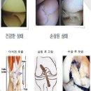 십자인대파열-십자인대수술: 자가건과타가건 이미지