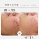 중앙동325 | 안산 피부관리•안산 여드름 관리 잘하는곳 3회 후기•모모스킨안산점•중앙동 피부샵