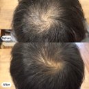 성장인자두피탈모 마곡루미에르 본점 | 마곡두피관리, 어느 곳으로 방문하면 좋을까요?