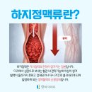 하지정맥류의 치료와 예방 | 하지정맥류의 치료와 수술 방법