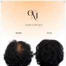 에스엠컨설팅 - 서초구 서초중앙로20길 16 | 대구두피문신 온미SMP대구, 달서구두피문신 고민 해결한 후기