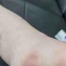 (주)제뉴파마 | 멍크림, 멍연고 &#34;베트라겔&#34; 사용 후기 / 리뷰