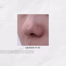 길음역 피부과 한의원 피부관리 코 모공 흉터 제거 새살침 6회 후기