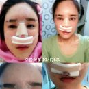 [여우야 카페1탄] 코(비중격+고어실리),앞트임재수술,지방이식(얼굴전체),턱보톡스 이미지