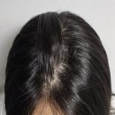 코리아병원 | 볼빅 미토코리아 병원 탈모샴푸 후기