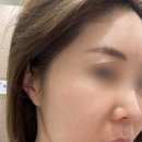 화순 미 의원 | 화순 한양미의원에서 엑실리스 리프팅 리얼후기