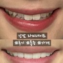 행복한최치과의원 | 강남역치과 무삭제 라미네이트 전후 사진, 통증 후기 (가격 공유)