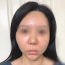 청담쟈스민라인의원 | 청담 피부과의원에서 꺼진 팔자 쥬베룩 볼륨으로 채우고 만족하고 온 후기