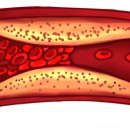 고지혈증의 이해와 관리 이미지