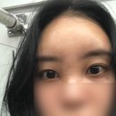 강남 피부과 이마필러 붓기 멍 부작용 정리 후기