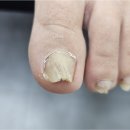 산북초등학교 | 군산 미장동 내성발톱 두껍고 말린다면 골든풋 군산점 비엔네일 추천!