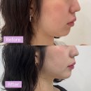 명한의원 | 부산 서면 한의원 다이어트약 온다리프팅 후기 당일 1주 차