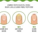 손톱 조갑박리증 원인 증상 손톱들림 손톱빠진 손톱염증 치료방법 이미지