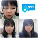 박종수신경외과 | 프리미엄 5일 기적 후기 (요요없는, 얼굴붓기빼는)