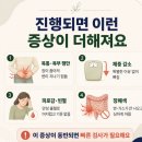 대장암 진행되면 나타나는 증상 이미지