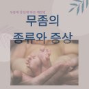 미플러스약국 | 무좀의 종류에 따라 치료법이 달라져야 한다.