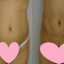 복부 지방흡입 한달 반 됬어요~~~~ㅋㅋㅋㅋㅋㅋㅋ 이미지