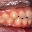 수원심미치과기공소 | 30대 치과위생사의 내돈내산 치아 교정 리얼 후기 (앞니 부분 교정/클리피씨/MTA 교정 기간)