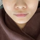 지라인 | 남양주 다산피부과,리니어지 300샷 후기, 추천, 주기