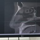 경희 - 남구 | 코뼈 골절.. 비관혈적 정복술 후기(경희의료원 2박 3일)