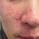 방이정형외과의원 | 정형외과 전문의의 안면(얼굴) 대상포진 치료 후기 [초기 증상, 후유증, 흉터, 사진 첨부]