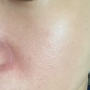 청담공의원 | 큰 모공에 효과 좋은 포텐자, 포텐자는 역시 청담공의원 / 포텐자 후기