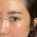 한우리약국 | (여의도피부과) 어바인 피부과 색소레이저 후기(4회차)
