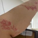 고래반점 | 세부 여행 고래상어 투어 중 해파리 쏘임, 1개월 경과 사진 후기 (치료 &amp; 관리 팁)