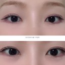 팝성형외과 | 팝성형외과 쌍수 4개월차 솔직 후기 자연유착 윗트임 눈밑지방재배치