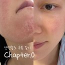 대도한의원 | 7년차 홍조인의 기록을 시작합니다 | 안면홍조 극복 일기 Chapter.0