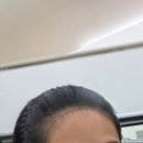 피씨엘코리아(PCL KOREA) 두피SMP 잘하는 곳 후기｜강남 헤어라인·강남구청역 헤어라인·강남 두피SMP