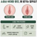 대전산부인과 질쎄라+소음순비대수술 후기