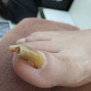 H nail