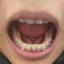 스마일치과 | [교정일기] 3개월차 후기_치아교정 거미스마일_연세굿데이치과 양재점