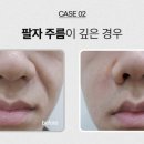 로데오피부과 네이버블로그