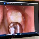 크라운치과기공소 | 용인 처인구 어린이치과 용인쥬니어치과 어금니와 크라운 사이에 고무줄 끼운 후기