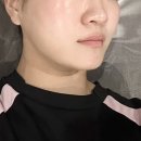 신사-116 | 신사역 피부과 리프티크 다운타임 없는 온다리프팅 7만줄 솔직후기