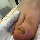 무스비네일