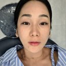 포에버의원 | #의정부피부과 [포에버의원] 스킨보톡스&amp;저통증리쥬란 후기